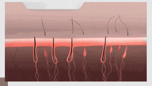 Top 5 IPL Hair Removers